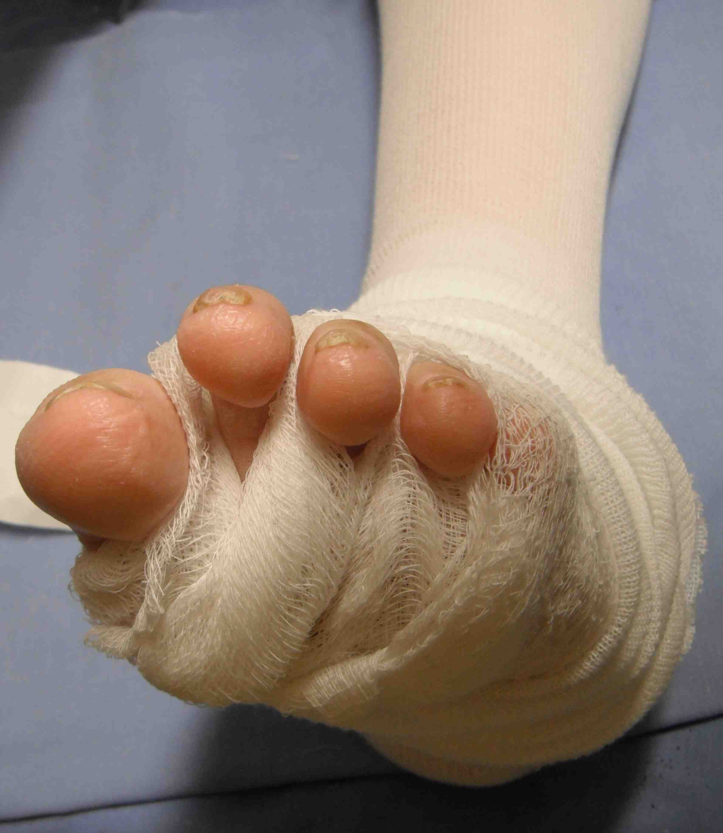 Total Contact Cast The Bone School